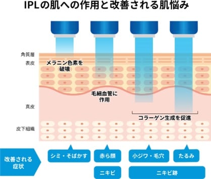 IPLの作用と効果