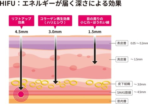 エネルギーが届く深さによるハイフの効果