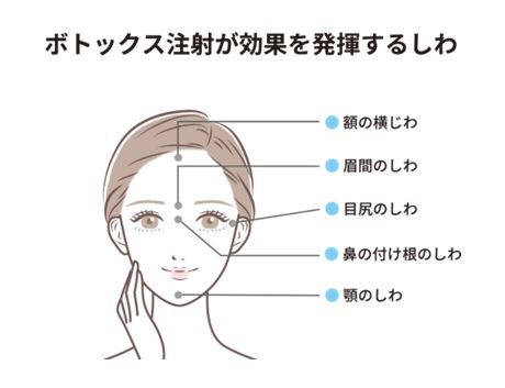 ボツリヌストキシン注射が効果を発揮するしわのイラスト