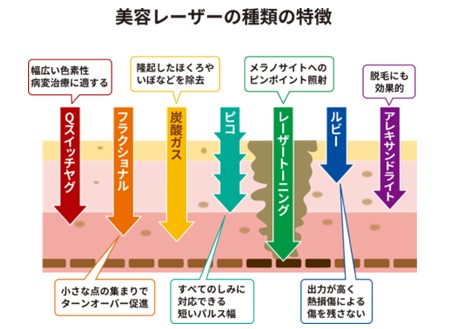 レーザーの種類