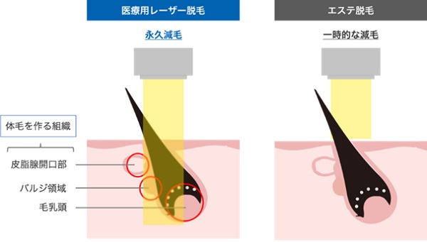 医療脱毛とエステ脱毛の違い