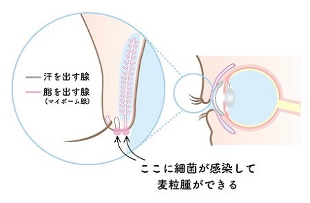 麦粒腫の原因