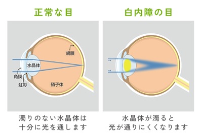 正常な目と白内障の目