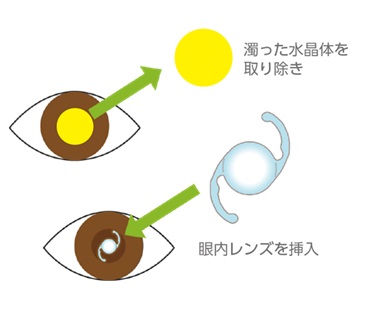 白内障の手術