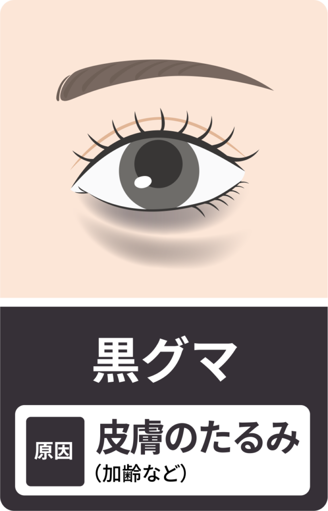 ためしてガッテンで紹介!目の下のたるみを取る方法!効果は美容医療とどう違う？ | エイジングケアを本気で学ぶ情報サイト｜ナールスエイジングケアアカデミー